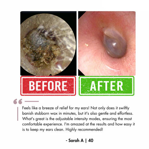 EarLox™ Electric Ear Wax Remover